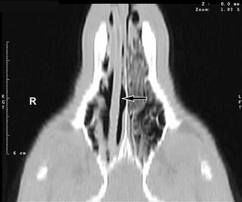 (A) Transverse image at the level of the midnasal region, demonstrating a target shape (arrow) with surrounding bony lysis.