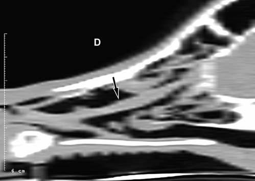 (B) Parasagittal, reformatted image through the right nasal cavity, demonstrating the tubular shape of the foreign body (arrow).