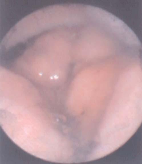 Multifocal filling defects (d), mild distension of the stomach, and caudodorsal displacement of pylorus are illustrated (F=fundus, P=pylorus, D=duodenum).