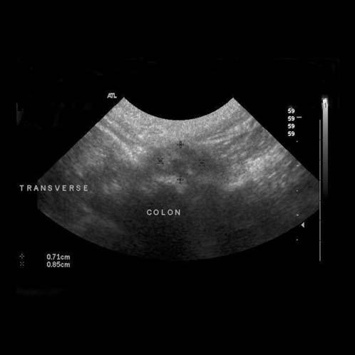 130 JOURNAL of the American Animal Hospital Association March/April 2007, Vol. 43 * + * + * Figure 2 Transverse abdominal ultrasound image of the cat in Figure 1, taken 17 months later.