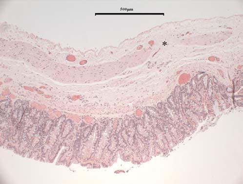 Figure 3 Histopathological image of the duplicated colonic segment removed at the third surgery, showing typical colonic layers, including mucosa, submucosa, tunica muscularis, and serosa.