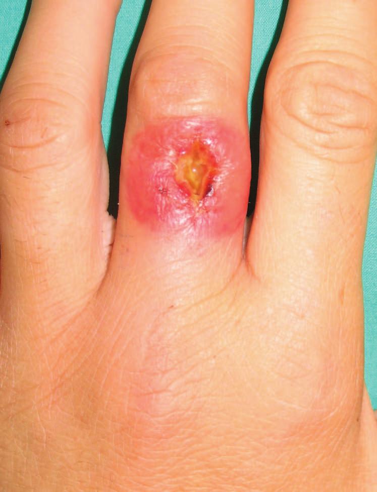 Volume 122, Number 4 Methicillin-Resistant S. aureus Fig. 1. Case 1. A 35-year-old woman presented with a communityacquired methicillin-resistant S.
