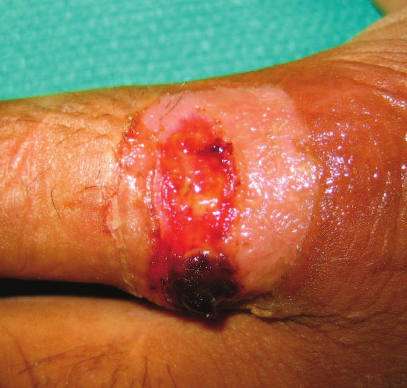 The lesion was unresponsive to outpatient therapy with oral cephalexin and she was admitted to the hospital for intravenous ampicillin-sulbactam and two local drainage procedures.