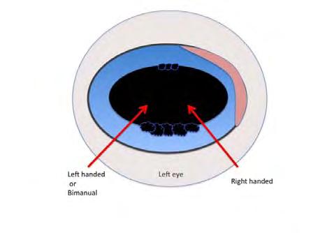 The left-handed surgeon would use an opposite approach. The goal is to avoid the corpora nigra (Fig. 2). Fig. 2A. 3 step corneal incision. From Coombes and Gartry, Cataract Surgery, BMJ Books. Fig. 2B.