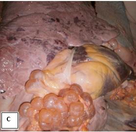 Old degenerated cyst and fibrosis in