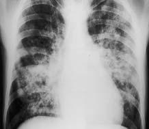 Diffuse Cocci Pneumonia Other Forms of
