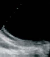 Active Transitional Inactive CL CE1 CE2 CE3 CE4 CE5 Figure 3: Ultrasound findings in cystic