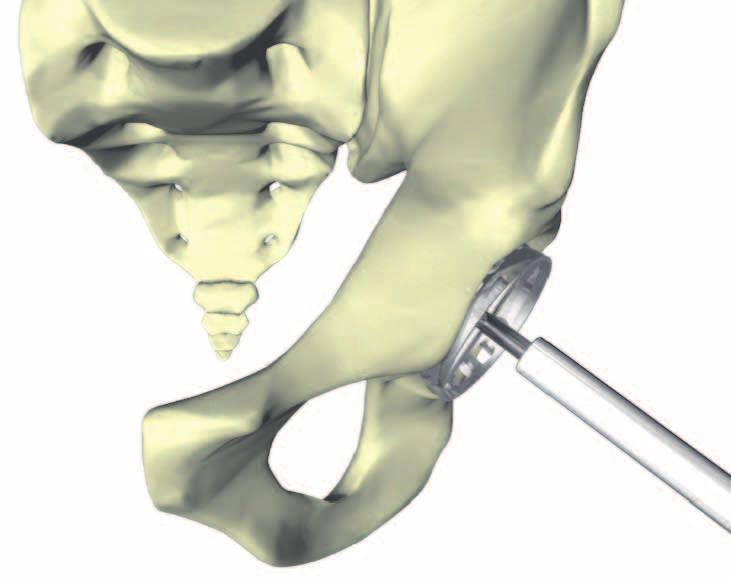 Indications Impactor Handle Assembly The Agilis Ti-Por system is indicated for all patients whose indication is the cementless implant, with