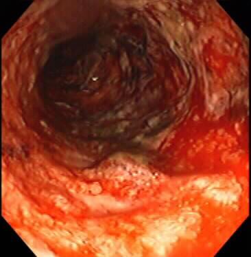 Pseudomembranous Colitis Appears as raised yellow or off-white plaques ranging up to 1 cm in diameter