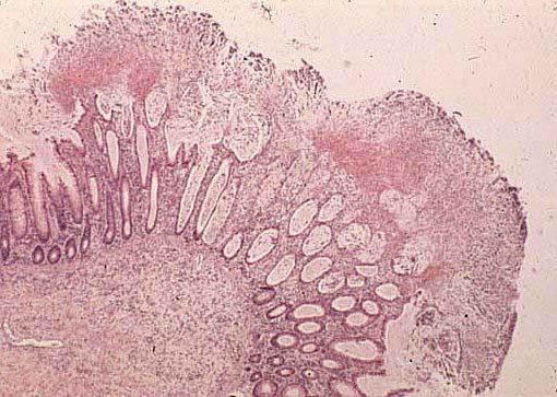 Histopathology of pseudomembranous colitis The pseudomembrane membrane is composed of fibrin Adheres to the damaged