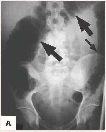 Toxic Megacolon Diagnosis based upon the finding of an enlarged dilated colon >7 cm in its greatest