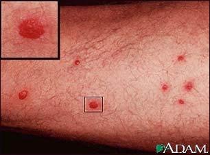 For example Cercarial dermatitis or Swimmers itch