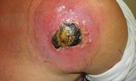 Gregory Moran, MD A cutaneous abscess, which had been caused by methicillin-resistant Staphylococcus aureus bacteria Gregory Moran, MD caused by MRSA A cutaneous abscess on the hand, by using altered