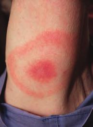 Lyme Disease Lyme disease is an illness caused by the spirochete bacterium Borrelia burgdorferi. In the Midwestern and Eastern U.S.