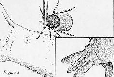 - If forceps are unavailable and index finger and thumb must be used, protect them with rubber gloves, plastic or even a paper towel. Figure 79B. Proper method for removing ticks Barriers Oils (e.g., baby oil, Avon Skin-So-Soft R skin softener) -- Present a physical barrier to some arthropods but do not repel or kill effectively.