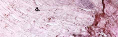 collagen fibers (a) surrounding the suture material with