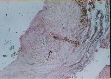 2: Photomicrograph of healing tendon 14 days after