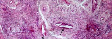 4: Photomicrograph of healing tendon, in group2 treated with