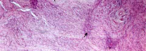 Notice proliferation of fibroblasts between bundles of