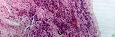 Fig.5: Photomicrograph of healing tendon, in group2 treated with Aloe vera gel 21 days after tenotomy.