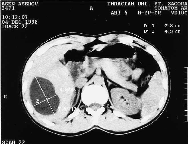 Liver CT showing a type I HEC with a hypodense rim surrounding the cyst. findings (Fig.