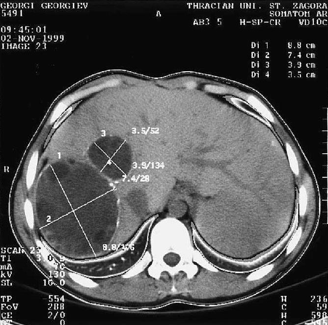 About 5% of the patients with liver cysts also exhibited a hydatid cyst on chest radiography. Eosinophilia was present in 40% of patients.