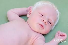 Albinism 1 in 17,000 births no pigmentation in hair, skin, eyes eye