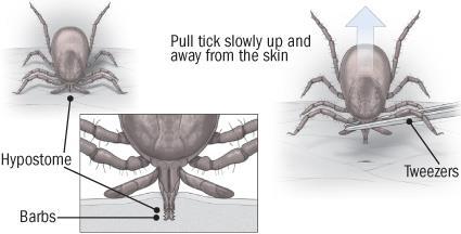 Proper Tick Removal Using