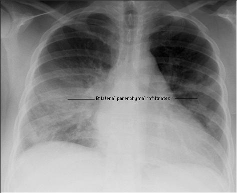 Case 1 Chest x ray: