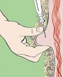 Usually a 1.6cm (5/8 inch) needle is ideal. After administration the site should be gently massaged. Intramuscular injections Intramuscular injections are made into muscle.