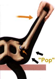 In a dog suffering hip dysplasia, femoral head has moved away from acetabulum Ortalani sign: an audible pop is heard as the femoral head slips back to the center