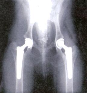 x-ray of a bilateral (both hips) total hip replacement DARthroplasty DAR stands for dorsal acetabular rim.