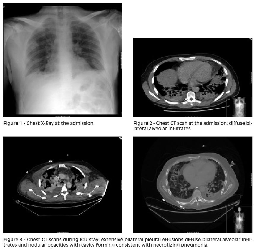 S. aureus http://www.microbewo rld.org/index.php?opti on=com_jlibrary&vie w=article&id=7611 Nosocomial pneumonia involving hospital-acquired (HA) S.