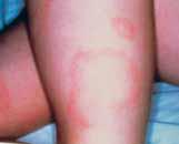 Symptoms of Lyme Disease Erythema Migrans Usually, the first symptom of Lyme disease is a red rash known as erythema migrans (EM).