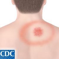 Acute Symptoms Occur within 3-30 days post bite Mean 7-10 days Erythema Migrans (EM) rash Seen