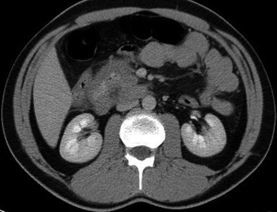Percutaneous Treatment of Primary Pancreatic Hydatid Cyst calcification was identified (Fig.