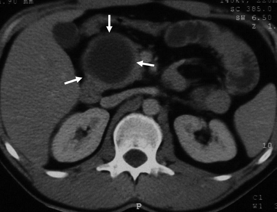 The differential diagnosis included pancreatic serous cystadenoma, pseudocyst, primary hydatid