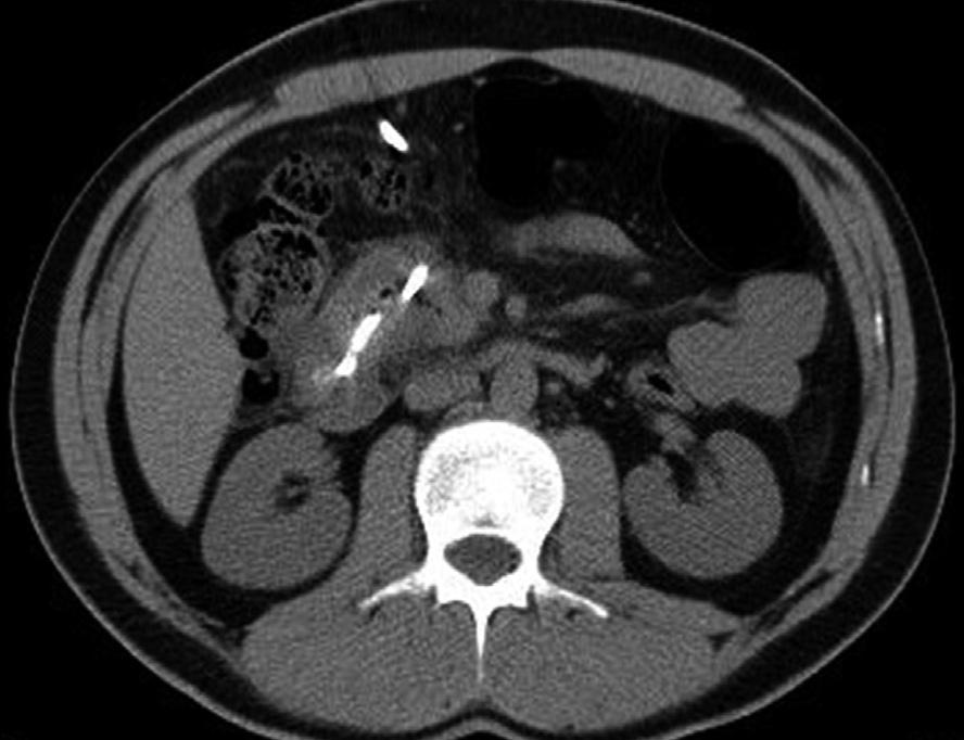Contrast-enhanced axial computed tomography (CT) images show cystic mass (white arrows) arising