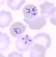TICK-BORNE ILLNESS Babesiosis: Malaria-like hemolytic disease Intra-erythrocyte protozoa Sx: often asx, fevers, malaise hepatosplenomegaly, jaundice