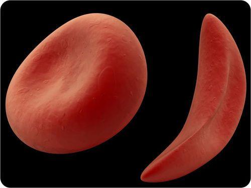 Sickle-Cell Anemia: Autosomal recessive Red blood cells are sickle-shaped, meaning they cannot carry