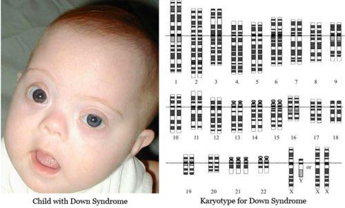 Down Syndrome: People with Down Syndrome