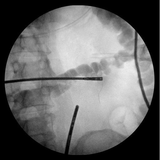 Kulkarni et al.: A Case Of Duodenal And Small Bowel Perforation Due To Grill Brush 13 Figure 10.