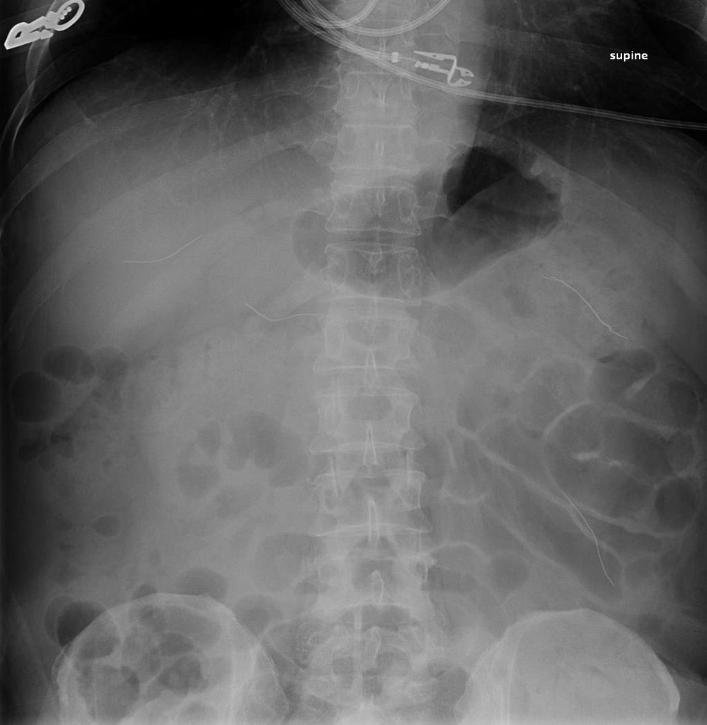 Kulkarni et al.: A Case Of Duodenal And Small Bowel Perforation Due To Grill Brush 5 Figure 2.