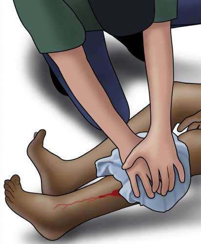 Apply continuous pressure with both hands directly on top of the bleeding wound 4.