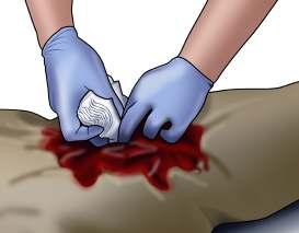 WOUND PACKING AND DIRECT PRESSURE If you do have a trauma first aid kit: For life-threatening bleeding from an arm or leg and