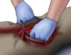 bleeding control gauze (also called hemostatic gauze), plain gauze, or a clean cloth and then apply pressure with both hands.
