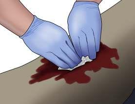 Pack (stuff) the wound with bleeding control gauze (preferred), plain gauze, or clean cloth. 12 4.