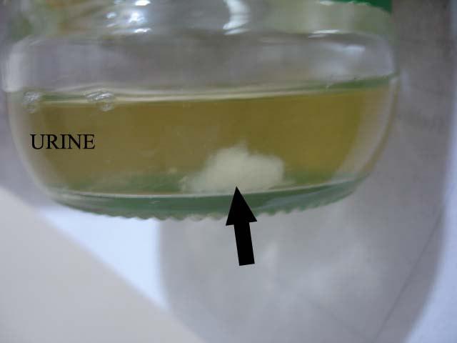 FIGURES Figure 1 (left): 25 year old male with renal hydatid cyst Patient s urine sample revealed hydatiduria seen as whitish material partially