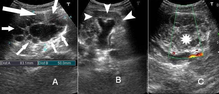 Kidney is replaced by a multiseptated cystic structure (arrows). (B) Upper pole of the kidney revealed hydronephrosis (arrowheads).