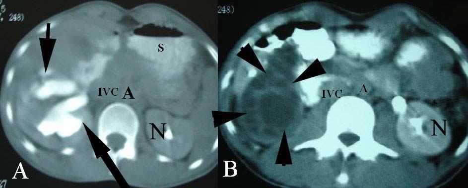 Figure 4: 25 year old male with renal hydatid cyst.